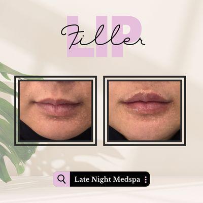 Lip filler