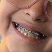 1.5 years Phase 1 braces