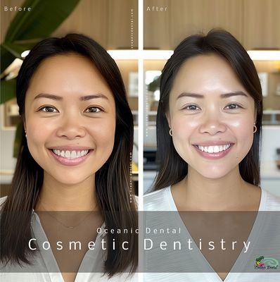 Transform stained, crooked, and misaligned teeth into a beautiful, healthy, and natural-looking smile.