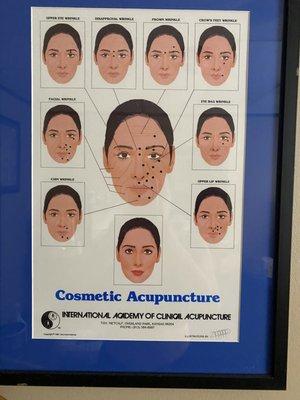 The healing power of acupuncture facelift.