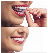 We offer Invisalign, the nearly invisible braces.