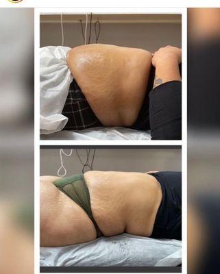 Fat removal