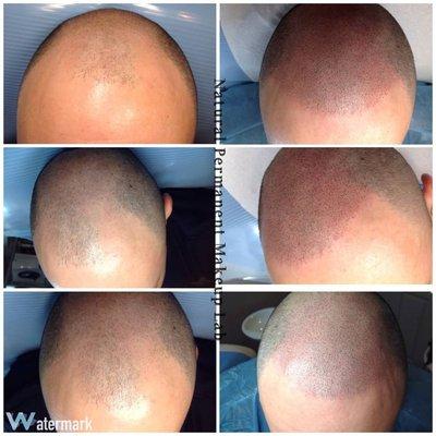 Scalp Pigmentation