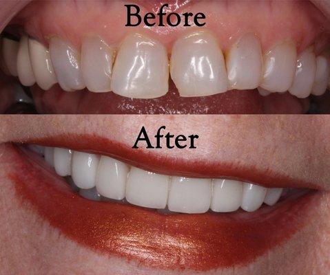 Prepless Veneers