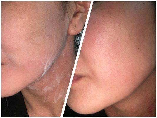 Microdermabrasion and hydrofacial result.