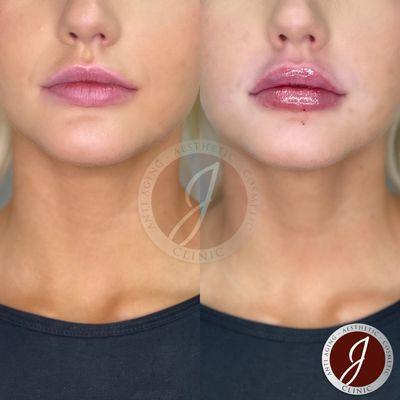 Lip Augmentation