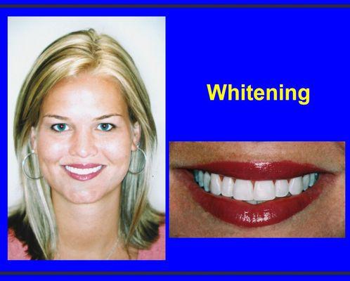 Whitening