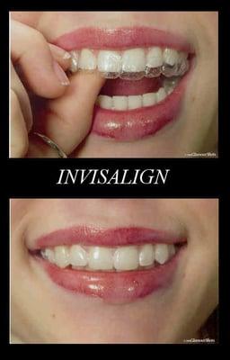 Invisalign