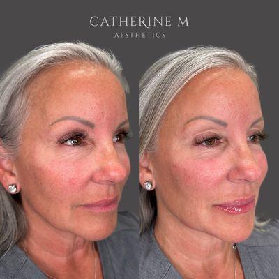 Liquid Facelift using filler.