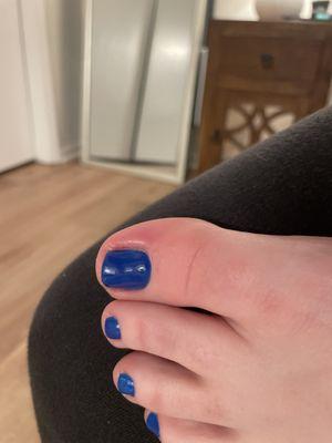 Infected big toe