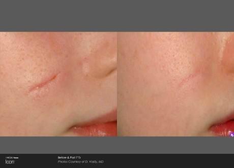 Scar Removal