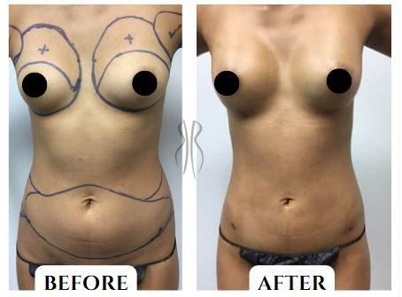 Before & After: Fat transfer to breasts