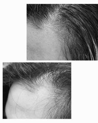 Receding hairline microblading