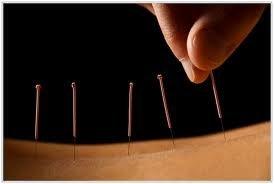 Acupuncture