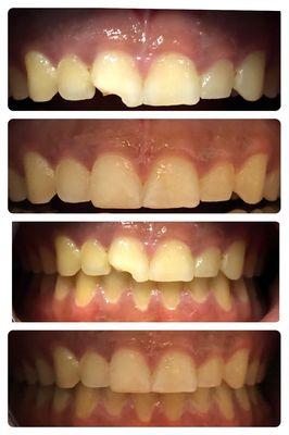 My son's tooth... before and after.