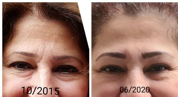 My pictures 5 years ago and now after 2 fibroblast treatments. I'm so happy with  the results.