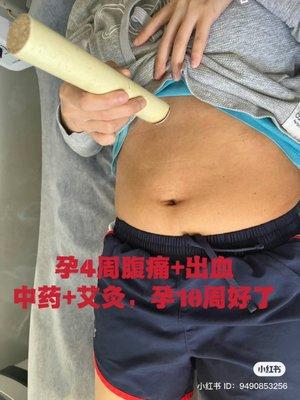 4 weeks pregnant. Cramping plus bleeding. Use moxa-moxibustion until week 10. Bleeding Stop.