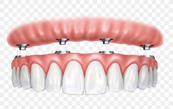 Denture Implants using titanium posts to stabilize the denture.