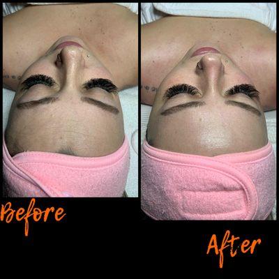 Dermaplane Facial