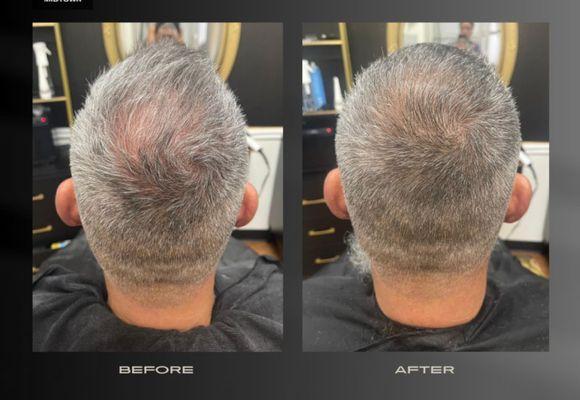 Before and after of hair loss treatments. A full crown!