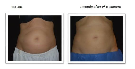 CoolSculpting Before And After