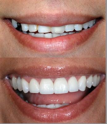 Cosmetic Smile B4/After