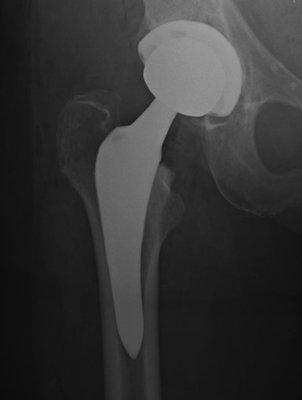 Total Hip Arthroplasty