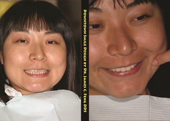 She wanted a 'cute' smile and we sculpted a set of veneers to deliver the look she's after.  Our veneers can be customized.