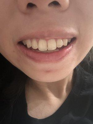 Picture of slight middle gap where the two front teeth no longer entirely touch.