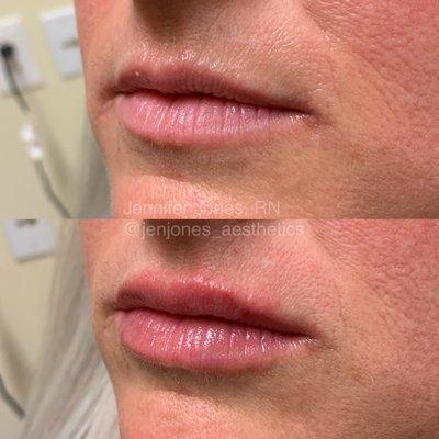 Lip Filler