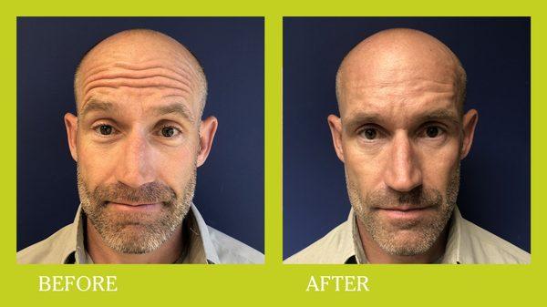 Botox and Fillers in man in his 40's.