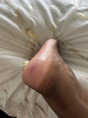 Injury from pedicure