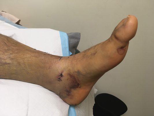 what my foot / ankle look like days after the surgery of my plafond fracture