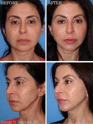 Cheeklift; Lateral Brow Lift; Full Face Laserbrasion Patient is 47 Years Old