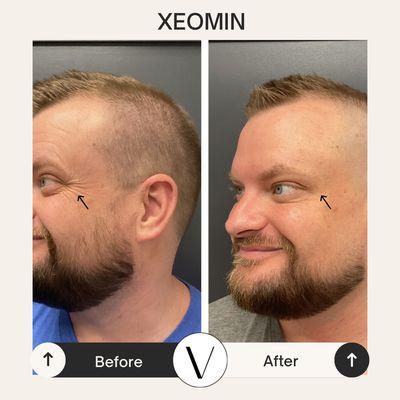 Xeomin before and after