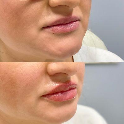 Before & After of Juvederm Lip filler.