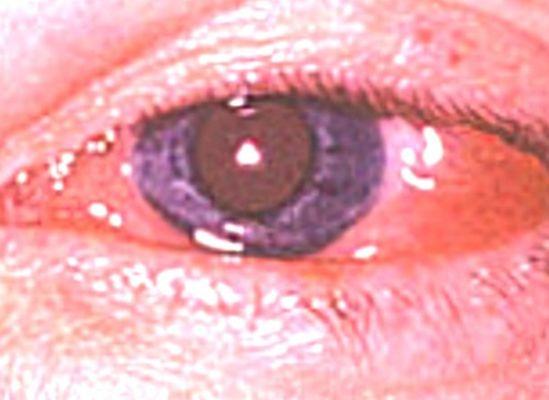 Epidemic keratoconjunctivitis diagnosed & treated at Master Eye.