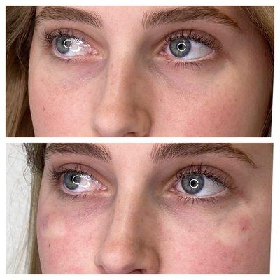 Under Eye Filler by Nurse Lindsey