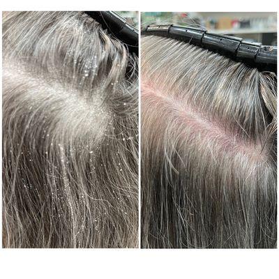 Before and after scalp treatment!