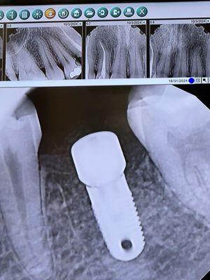 Molar Dental Implant