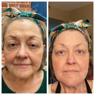 Peptide Face lift