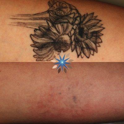 Laser Tattoo Removal