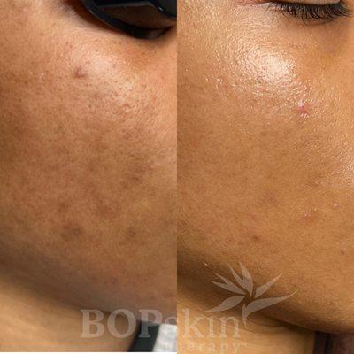 Acne Recovery treatment And one BioRepeel . Working on pigmentation and acne control. Seven month progress