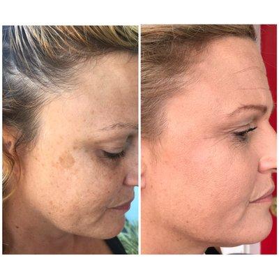 Plasma lift sun spot removal