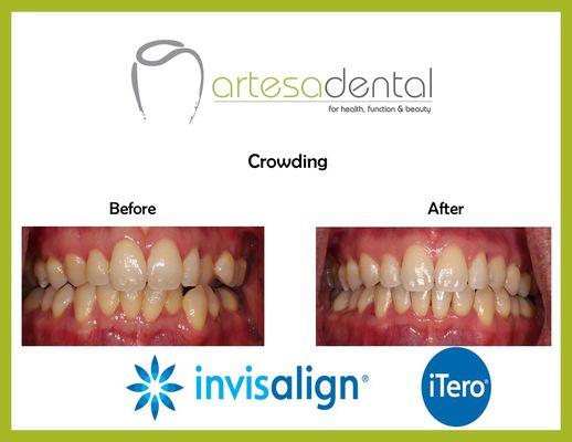 Invisalign is an amazing option to straighten your teeth.