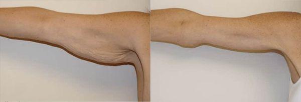 Before and After Brachioplasty (Arm Lift) by Dr. David Feldmar | Feldmar Aesthetics Beverly Hills, CA