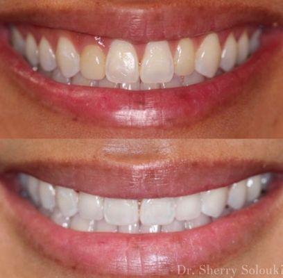 Two veneers were placed here to replace her old composite bonding