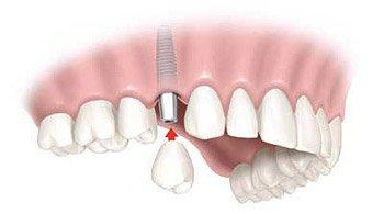 Nobel Biocare Implant and implant crown