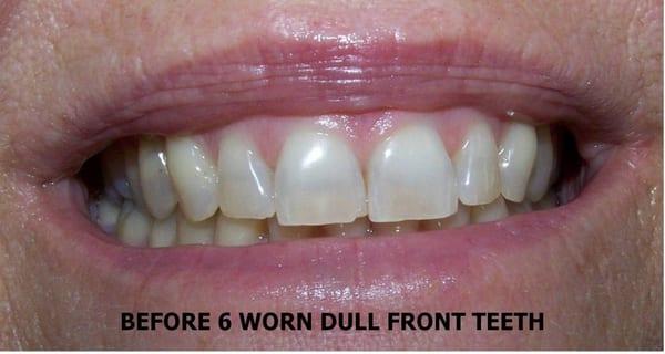 Before Porcelain Veneers to cover dark, worn teeth