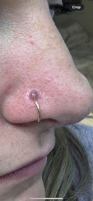 Keloid, permanent damage